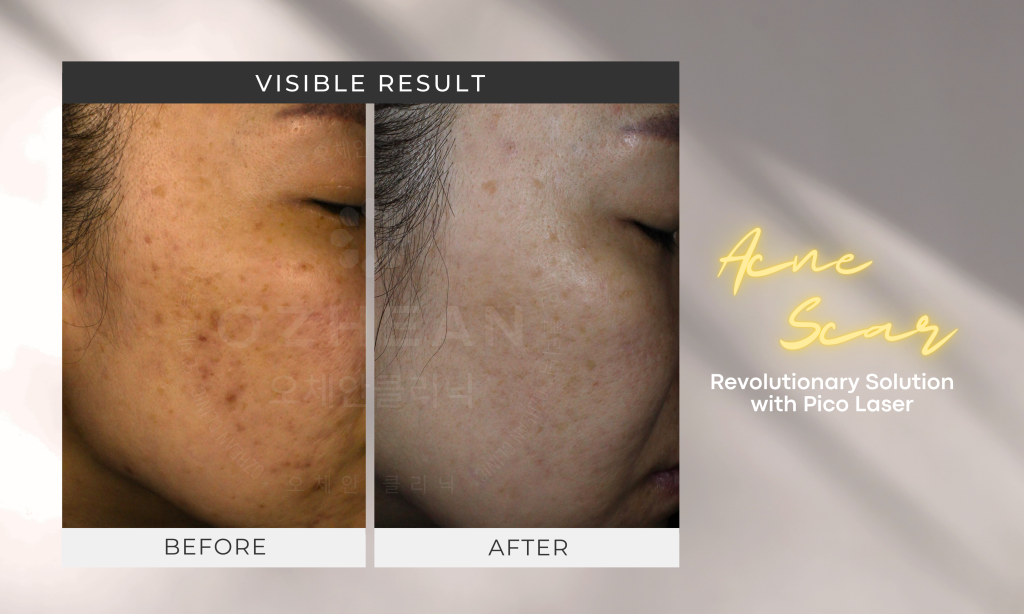 Unlock the Benefits of Pico Laser Treatment