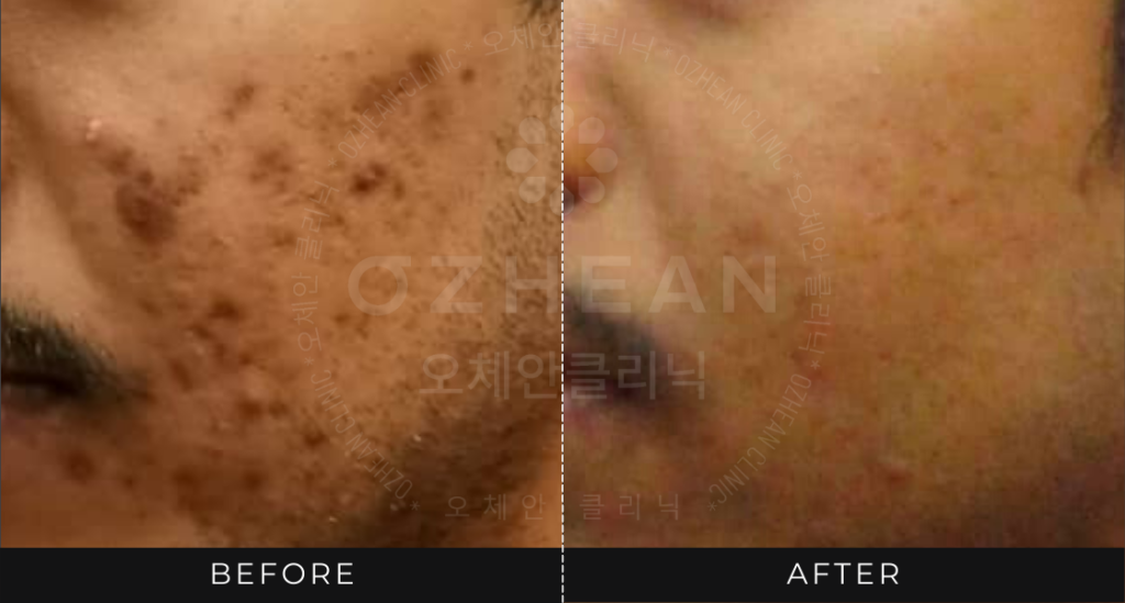 Ozhean Clinic - Acne Scar 1