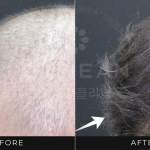 Ozhean Clinic - Hair Loss 2