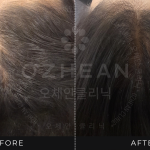 Ozhean Clinic - Hair Regrowth 5