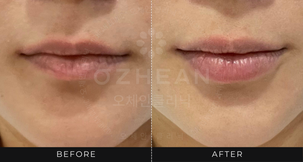 Ozhean Clinic - Lips Filler 1
