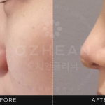 Ozhean Clinic - Nose Thread 3