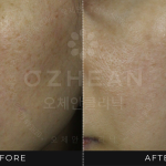 Ozhean Clinic - Pigmentation 2