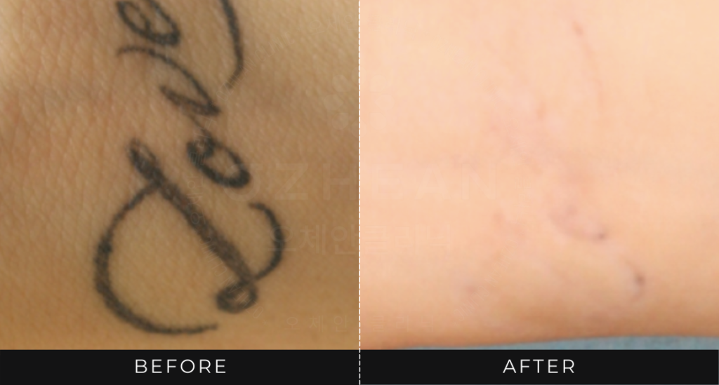 Ozhean Clinic - Tattoo Removal 1