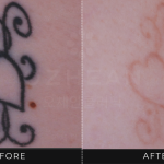 Ozhean Clinic - Tattoo Removal 2
