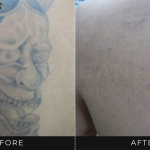 Ozhean Clinic - Tattoo Removal 3