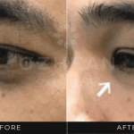 Ozhean Clinic - Under eye 1