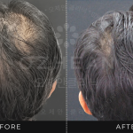 Ozhean Clinic - Hair Loss 1