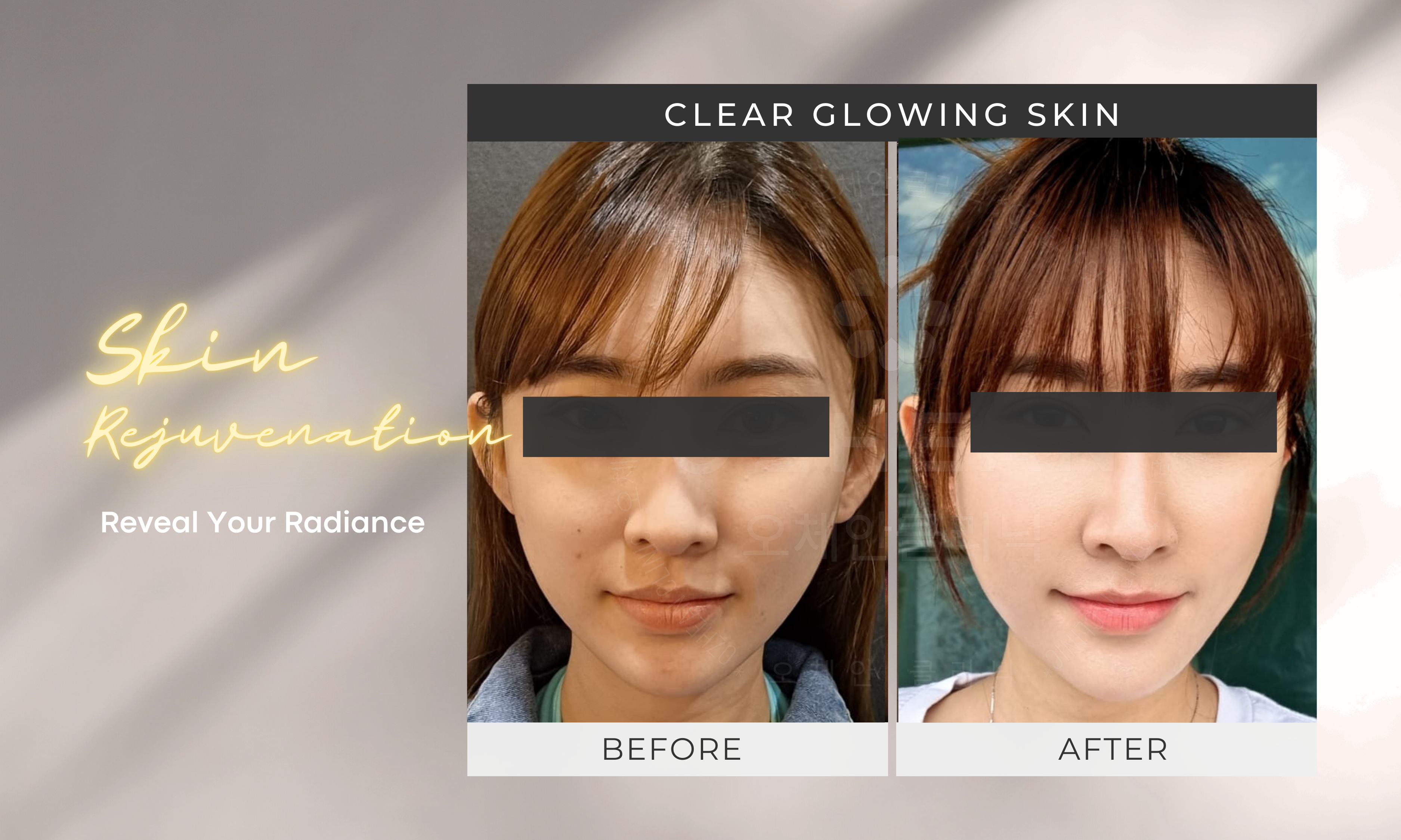 skin rejuvenation with pico laser
