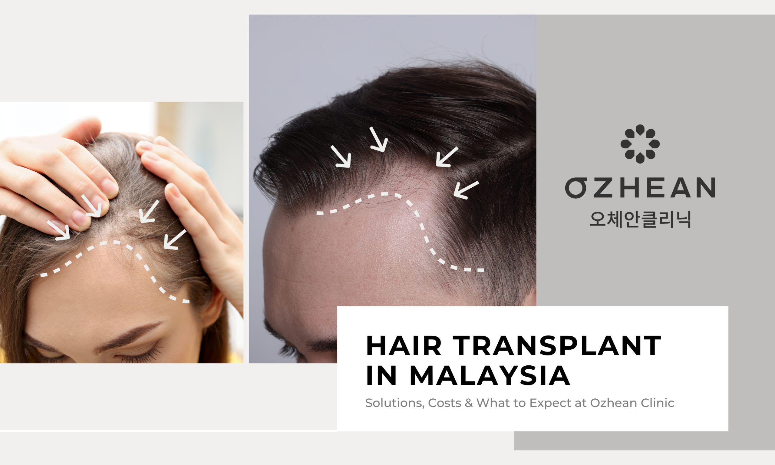 Hair Transplant in Malaysia: Solutions, Costs & What to Expect at Ozhean Clinic