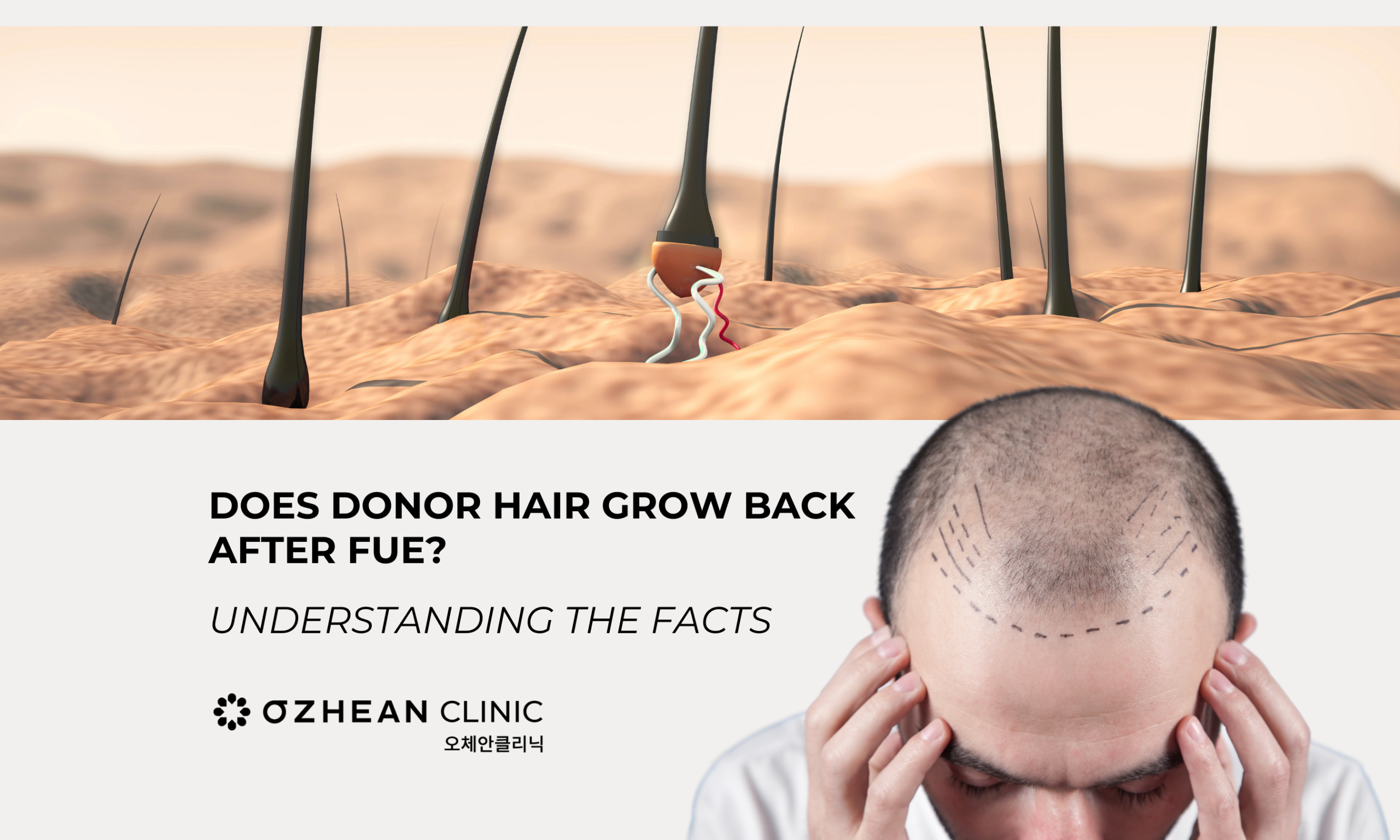 Does Donor Hair Grow Back After FUE? Understanding the Facts