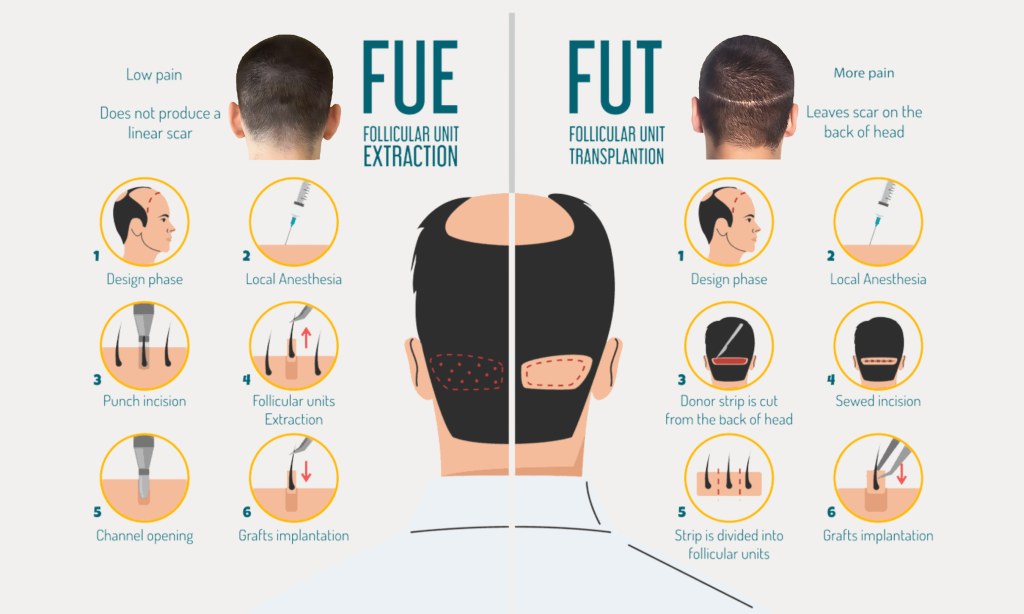 hair-transplant-ozhean-clinic-hair-growth-2