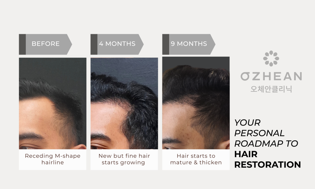 hair-transplant-ozhean-clinic-hair-growth-4