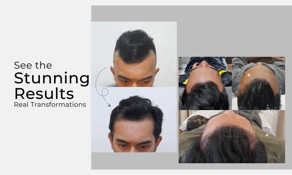 hair-transplant-ozhean-clinic-real-patient