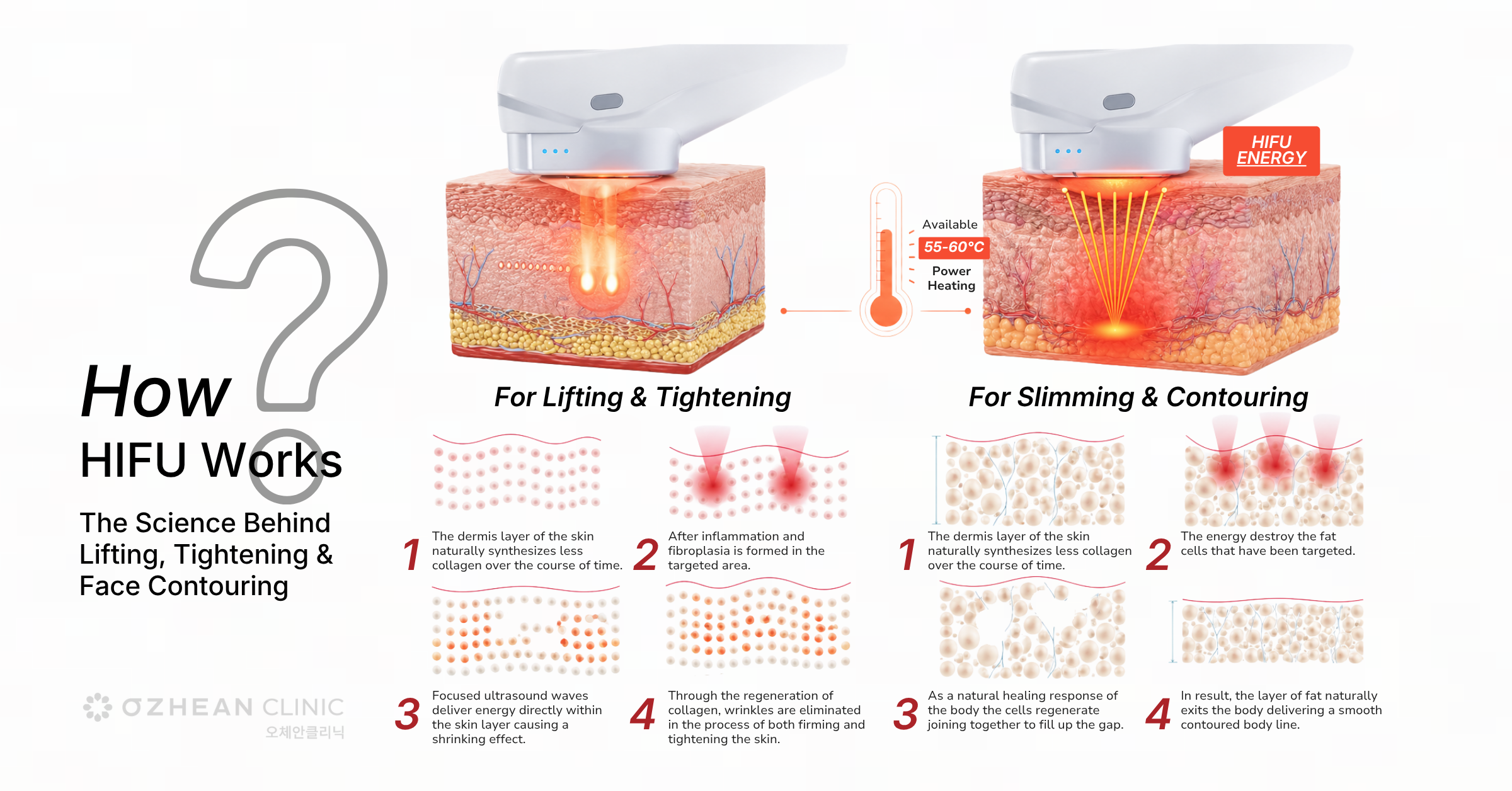 how-hifu-works-ozhean-clinic